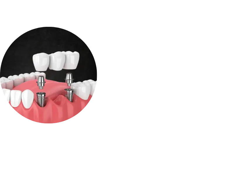 Implant supported bridge