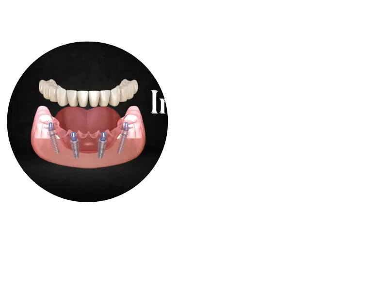 implant retair denture