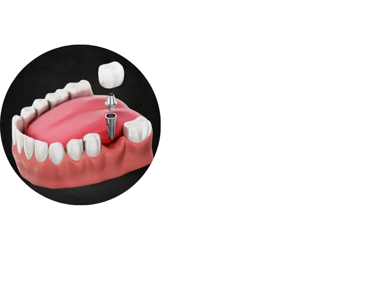 single tooth implant