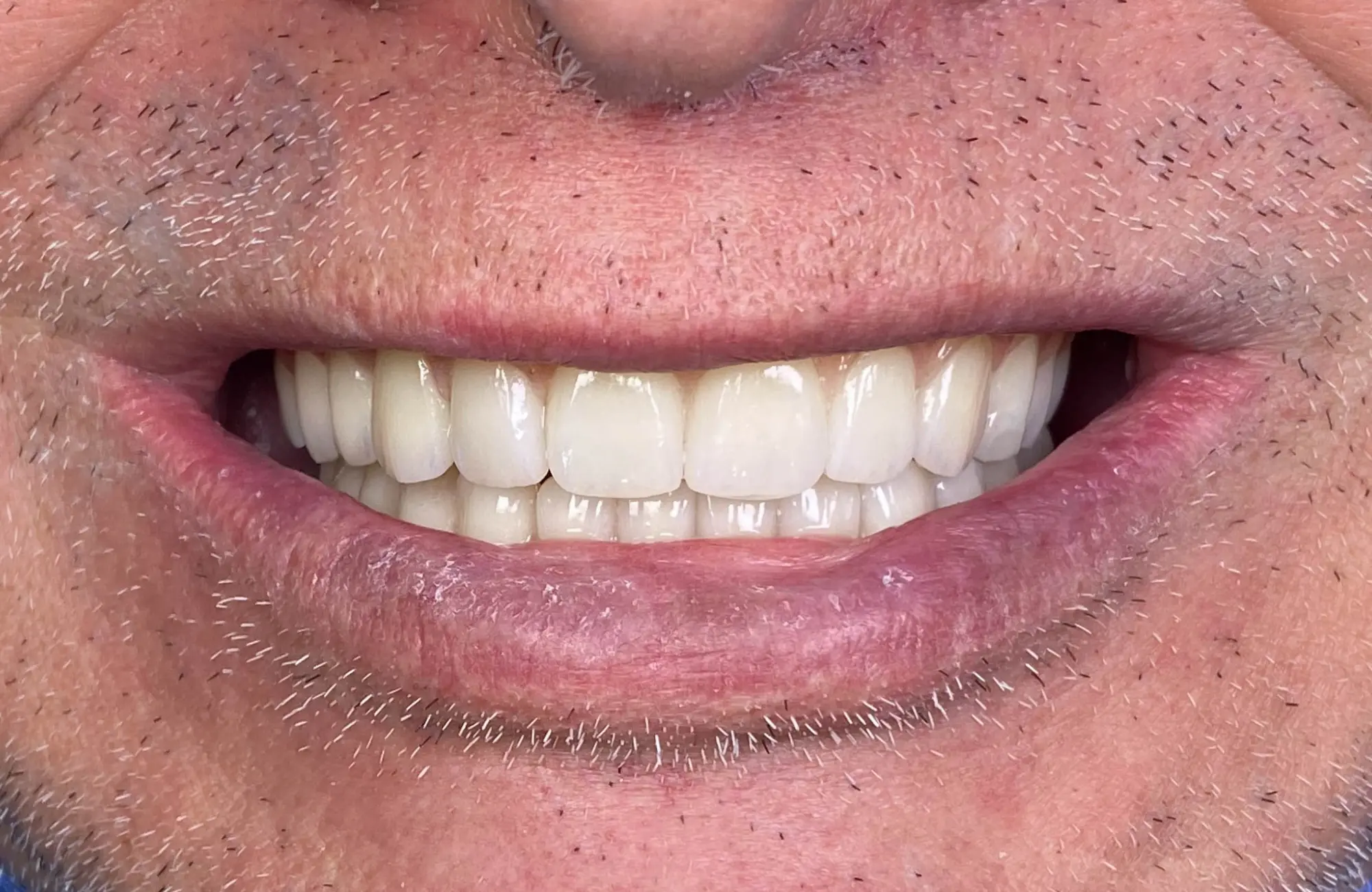 teeth after dental implants