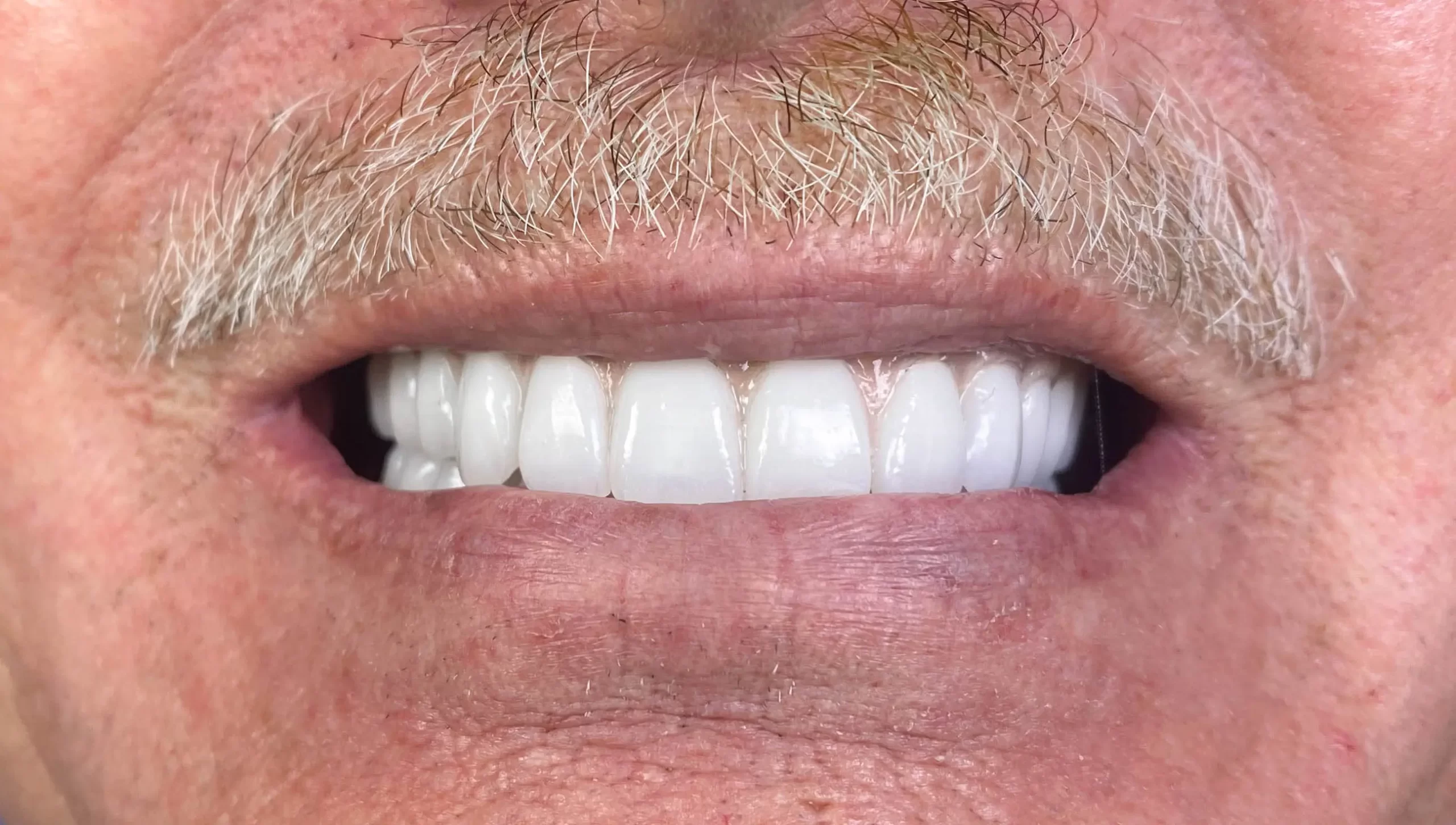 after dental implants