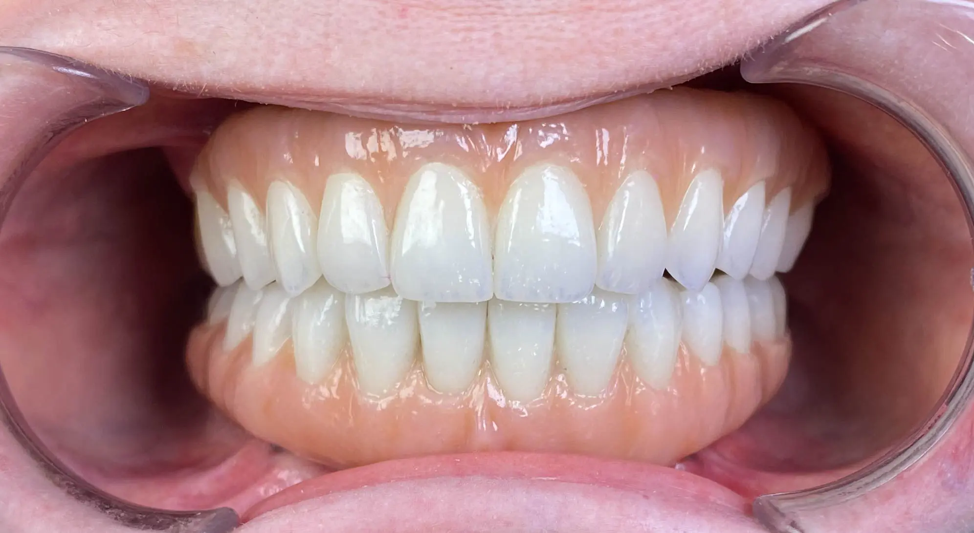 Advanced dental implants After